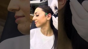 Forward Helix Piercing İşlemi