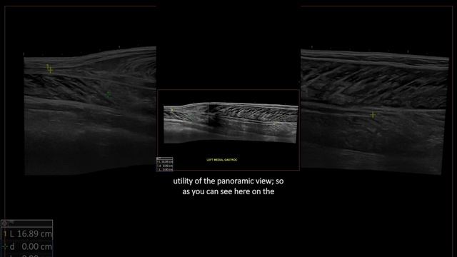 #ultrasound Guided Interventions: Cases (Gastrocnemius Tear)