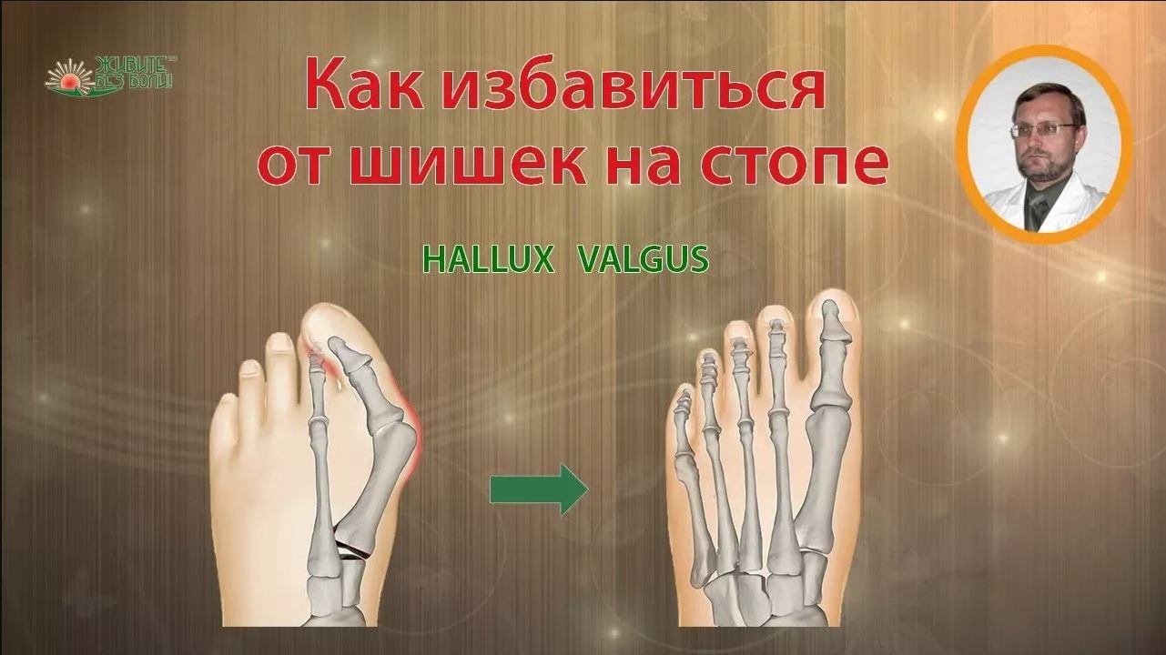 Как избавиться от косточки или шишки на большом пальце стопы _ Hallux Valgus смотреть онлайн