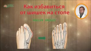 Как избавиться от косточки или шишки на большом пальце стопы _ Hallux Valgus