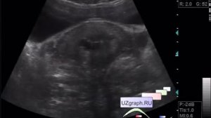 УЗИ малого таза - Гиперэхогенные точечные микровключения в шейке матки