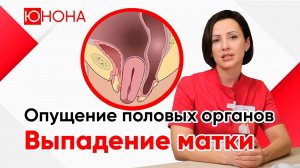 Опущение половых органов. Выпадение матки. Генитальный пролапс
