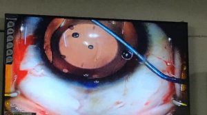 Toric Implantable Phakic Lens implantation for High Myopia Dr Suresh K Pandey SuVi Eye Hospital Kot