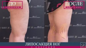 Липосакция внешней и внутренней поверхности бедра, околоколенной области