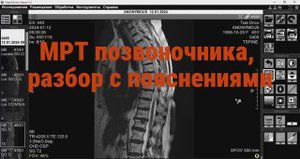 МРТ позвоночника, грыжи дисков.