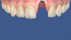 Имплантация и протезирование резца/переднего зуба после резорбции - ДокторСтом Краснодар