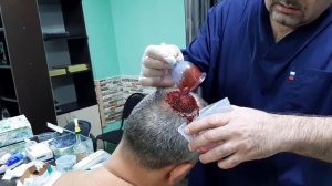 Хиджама - голова. Обучение, курсы Гирудотерапия, Хиджама, Массаж. Здоров 100 лет, Сертификат, Москв