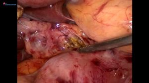 Laparoscopic choledoholitotomy&IPOM hernia repair LIVE_ Холедохолитотомия&пласти.mp4