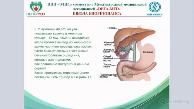 Камни в желчном пузыре 2022.01.19