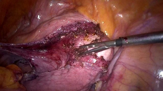 Промонтофиксация