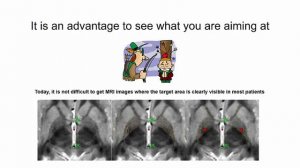 Targeting in stereotactic functional neurosurgery