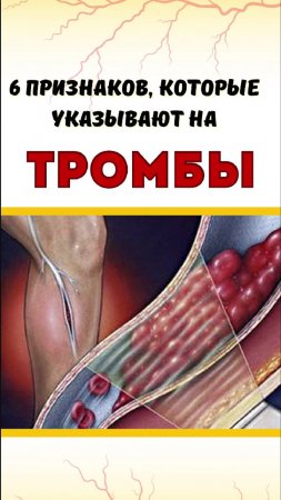 Шесть признаков тромбоза