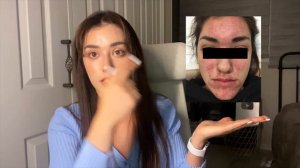 Моя история АКНЕ + Корейский ежедневный уход