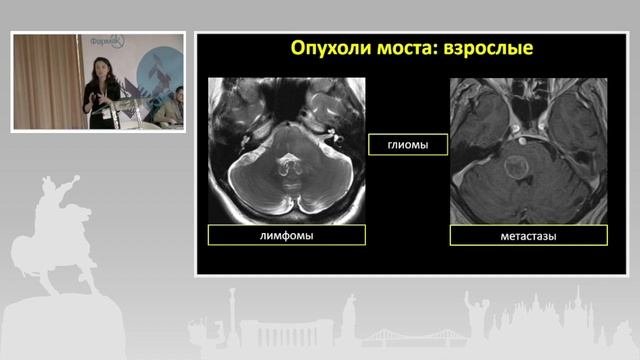 Ирина Трофименко. Топический подход в нейрорадиологии: Мост