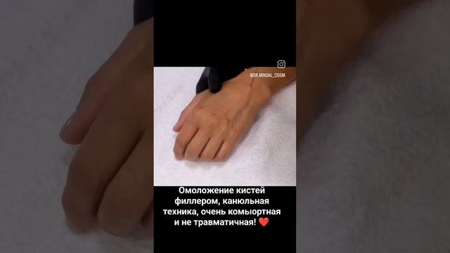 Омоложение кистей филлером!❤️ #cosmetology #руки #омоложениекожи #инъекции #контурнаяпластика