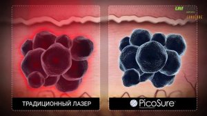 Cynosure Picosure PicoSure - первый в мире эстетический пикосекундный лазер для удаления татуировок