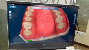 HELIOS 600 (EIGHTEETH). Обзор интраорального сканера.