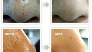 Черные Точки. Как Убрать Черные Точки На Лице. - Черные Точки На Лбу