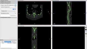 DICOM to STL (Перевод МРТ или КТ в 3D-модель)