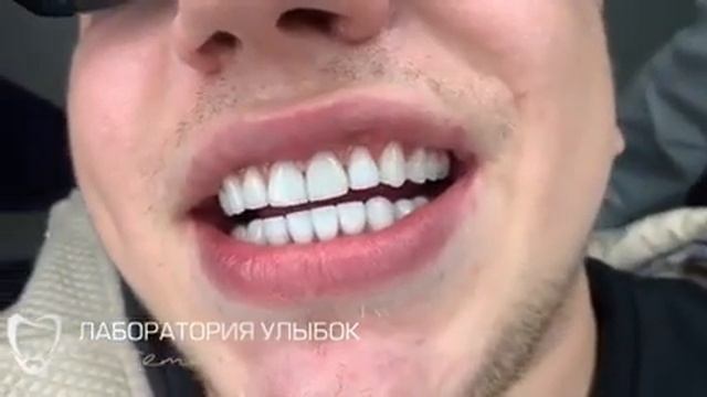 Керамические виниры