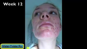 Роаккутан - средство против прыщей. Купить Роаккутан изотретиноин для устранения акне.