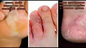 ★ Как избежать заражения грибком стопы: важно знать всем, кто собрался в отпуск!