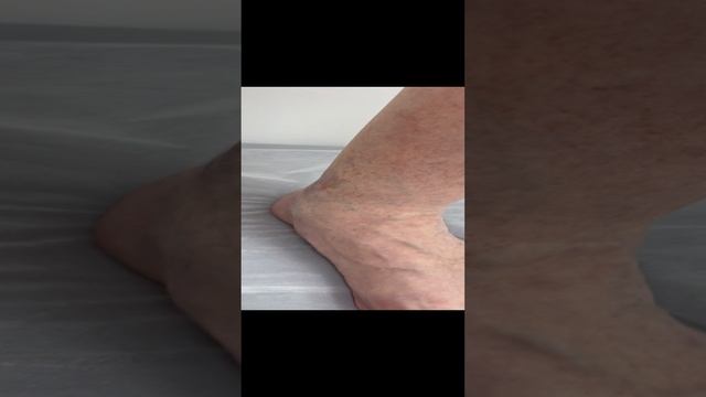 Сосудистая сетка на ногах. Склеротерапия противопоказана. Осмотр флеболога Москва. Флеболог смотреть онлайн