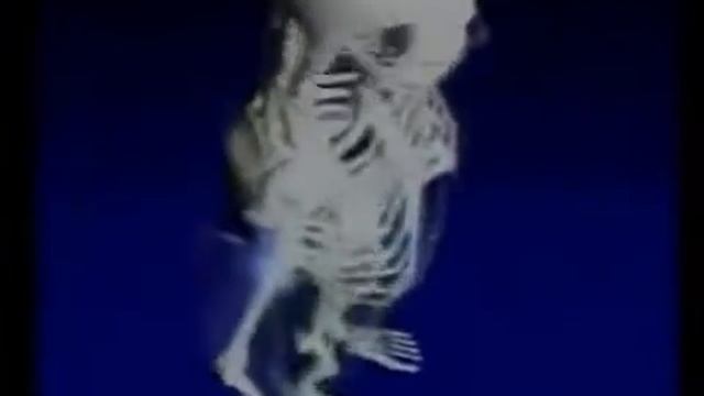 Остеопороз и Подагра. Лечение Щелочной ионизированной водой. смотреть онлайн