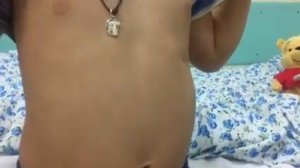 Вентральная грыжа