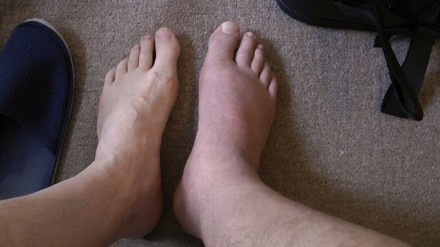 Перелом ноги і стопи смотреть онлайн