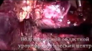 Ангиомиолипома правой почки