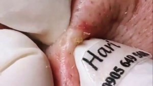 ✅ Чистка пор и выдавливание прыщей #15