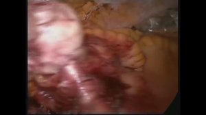 Лапароскопическая Аппендэктомия