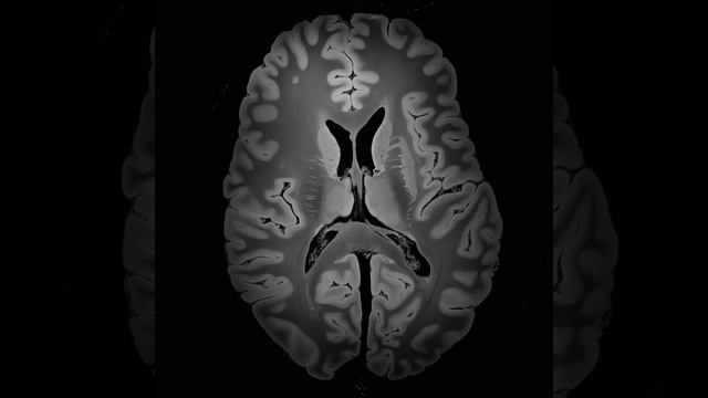 100 micron MRI scan of the human brain
