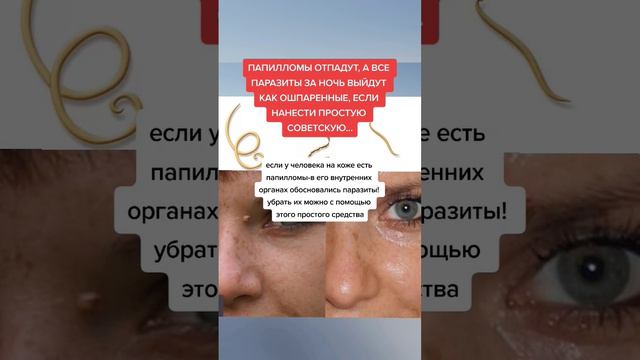 ПАПИЛЛОМЫ ОТПАДУТ А ВСЕ ПАРАЗИТЫ ЗА НОЧЬ ВЫЙДУТ КАК ОШПАРЕННЫЕ #народнаямедицина