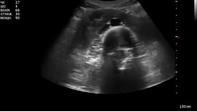 Диагностика подковообразной почки смотреть онлайн