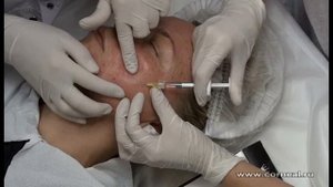 Биоревитализация - мелкопапульно и часто