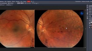Монтаж фундус-фотографий выполненных с помощью портативной камеры Aurora компании Optomed(Финляндия)