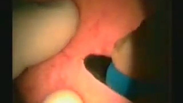 RF-ластик для удаления сосудов смотреть онлайн