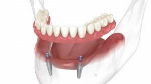 Съемный протез нижней челюсти по системе All on 2, поддерживаемый имплантатами