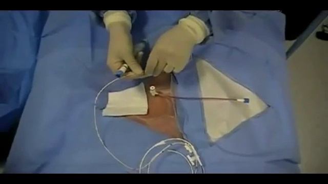 Аритмология  Внешний кардиостимулятор Insertion Of Transvenous Pacemaker