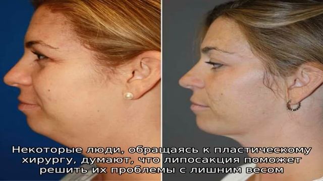 Липосакция подбородка – эффективное скульптурирование лица