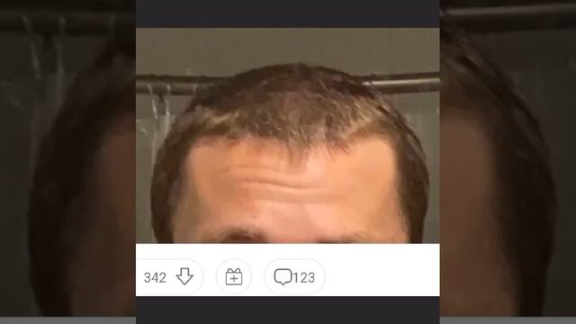 восстановление волос, андрогенная алопеция,ага,финастерид смотреть онлайн