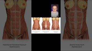 Диастаз. Диастаз и массаж