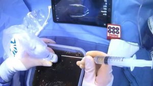 Giving Lidocaine/Draining Ascites For A Paracentesis (Yueh Needle With Ultrasound Guidance)