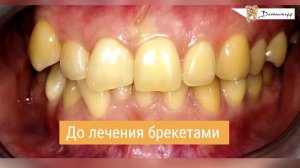 Брекеты или капы - что лучше