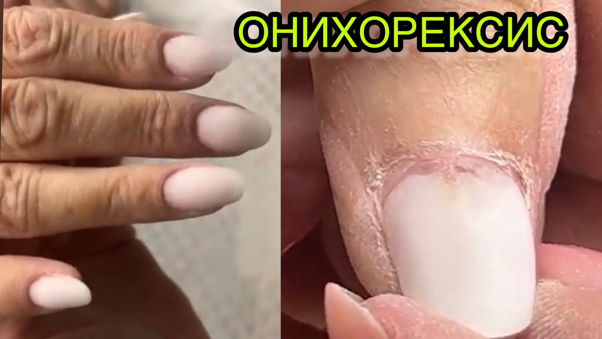 ОНИХОРЕКСИС