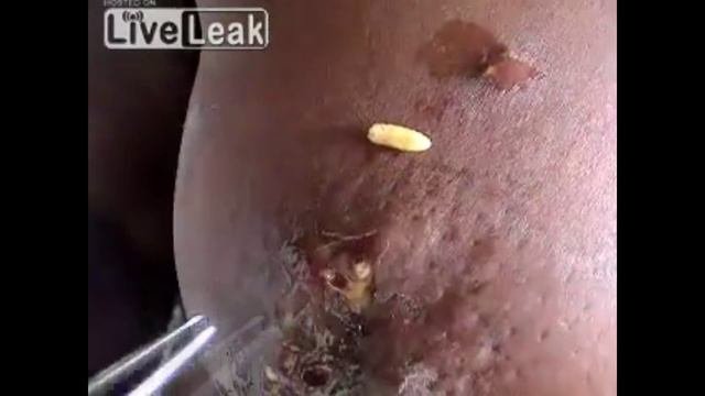 Опарыши в человеке