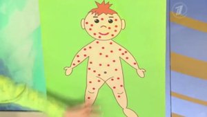 Ветряная оспа  Симптомы и лечение ветряной оспы народными средствами и методами