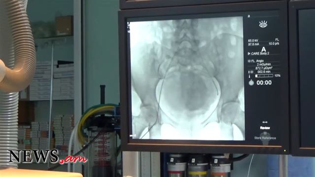 Uterine fibroids embolization Эмболизация маточных артерий